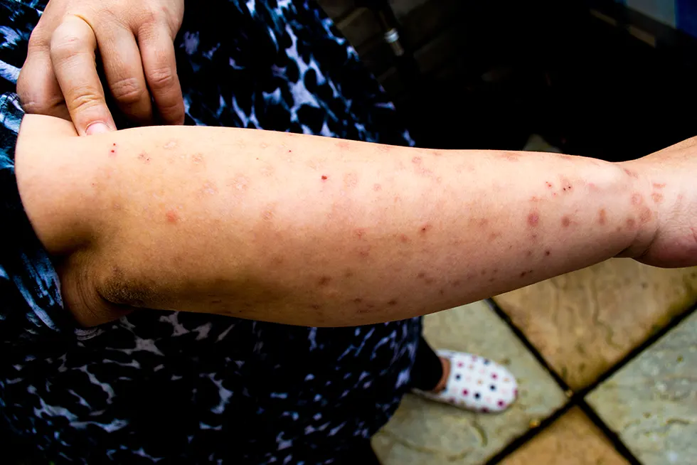 Piqûres de punaises de lit sur avant-bras